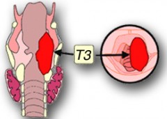 Cancers du larynx (cancers de la gorge)