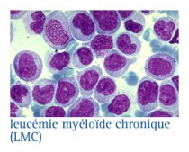 Leucémie myéloïde chronique