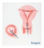 Cancer du corps de l'utérus