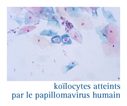 Frottis lesion papillomavirus - Hpv positif frottis normal Papillomavirus et frottis