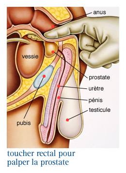 prostate maladie symptômes