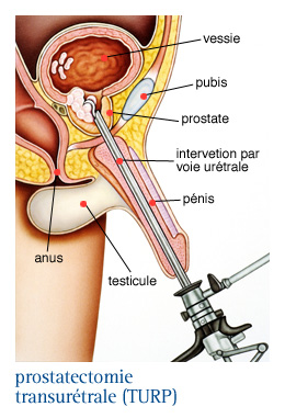 opération prostate effets secondaires