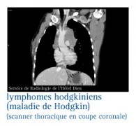 Lymphomes hodgkiniens (maladie de Hodgkin)