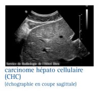 Cancers du foie (hépatocarcinome)
