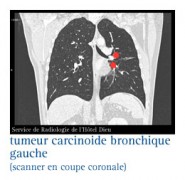 Cancers du poumon