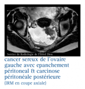 Cancer de l’ovaire
