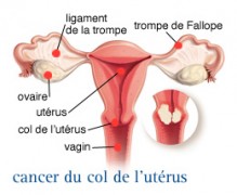 Cancer du col de l'utérus