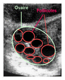 Cancer de l'ovaire