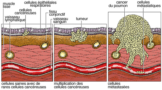 cancer cellule maligne cancer del peritoneal