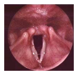 Cancers du larynx (cancers de la gorge)