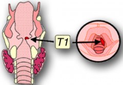 Cancers du larynx (cancers de la gorge)