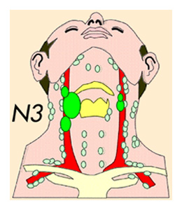 Cancer de la gorge (larynx) - Classification TNM / UICC 2017 des ...