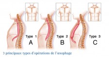 Cancer de l'œsophage