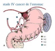 Cancer de l'estomac (gastrique)