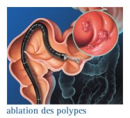 Cancer du côlon & du rectum