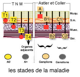 Cancer du côlon & du rectum