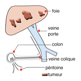 Les cancers secondaires du foie (métastases hépatiques) - Infocancer