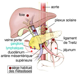 Les cancers exocrines et endocrines pancréatiques - Infocancer