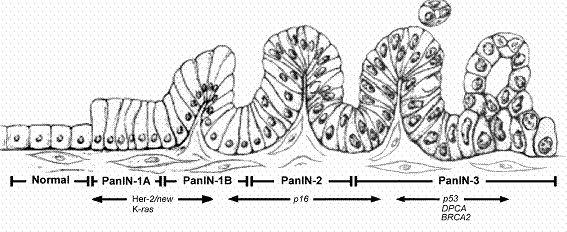 Cancer du pancréas