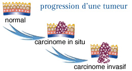 Cancer du testicule