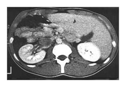 Cancer du testicule