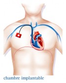 Cancer du testicule