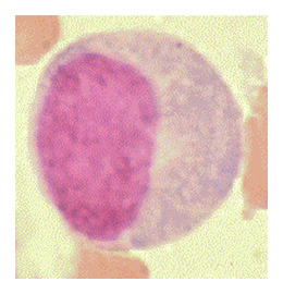 Leucémie lymphoïde chronique