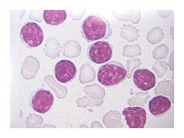 Que sait-on de la leucémie lymphoïde Chronique ? InfoCancer