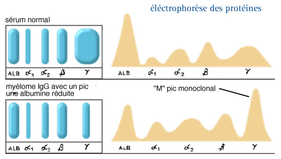 Myélome - diagnostic - immunoélectrophorèse - pic - Bence-Jones ...