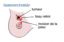 Cancer du sein