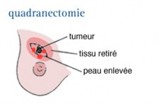 Cancer du sein