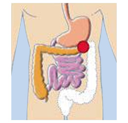 Cancer du côlon & du rectum