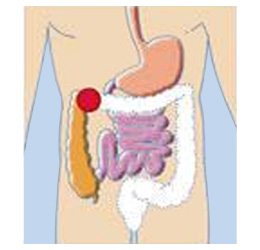 Cancer du côlon & du rectum