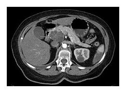 Le bilan initial d'un cancer du pancréas- Infocancer