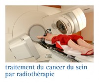 Cancer du sein