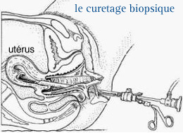 Cancer du corps de l'utérus