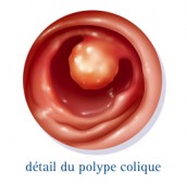 Cancer du côlon & du rectum