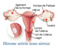 Les fibromes et l'endométriose - InfoCancer