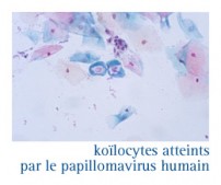 Cancer du col de l'utérus - Le frottis de dépistage - InfoCancer