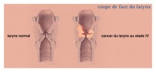 Cancers du larynx (cancers de la gorge)