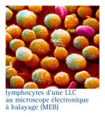 Leucémie Lymphoïde Chronique