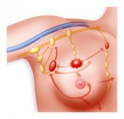 Comment opère-t-on un cancer du sein ? InfoCancer