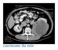 Quel bilan pour diagnostiquer un cancer du rein - Infocancer