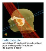 Cancers du larynx (cancers de la gorge)