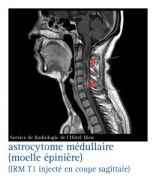 Astrocytome médullaire T1
