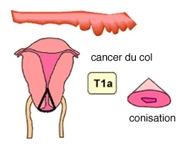 Cancer du col de l'utérus