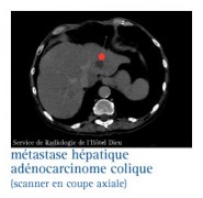 Cancer du côlon & du rectum (colorectal)