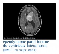 Tumeurs du système nerveux