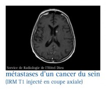 Quels sont les traitements du cancer du sein selon le stade ...