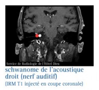 Tumeurs du système nerveux